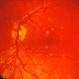 Punctate inner choroiditis Punctate inner choroiditis